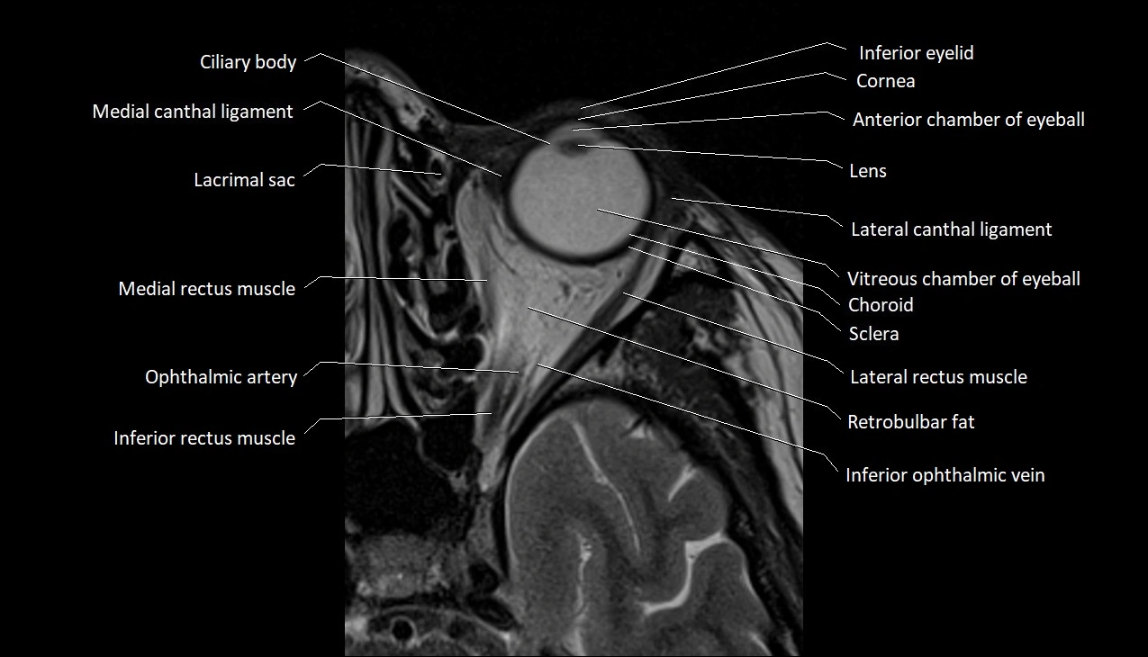 MRI Orbit axial cross sectional anatomy image 6.webp